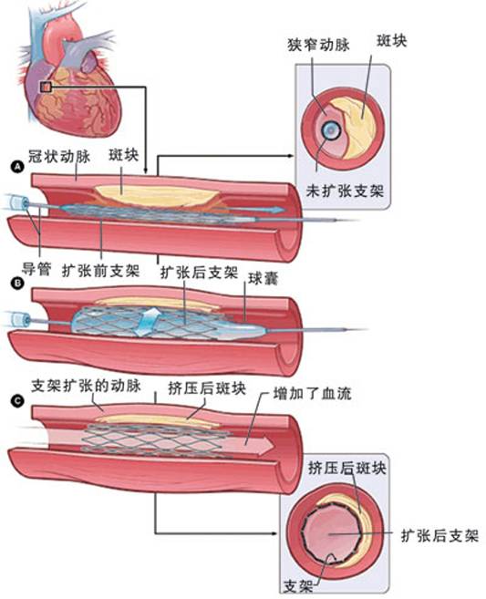 怎樣治療冠心?。?圖2)