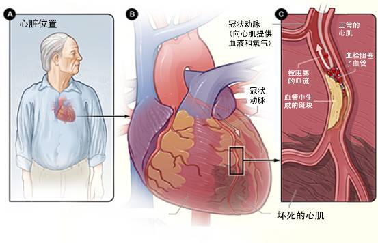 怎樣治療冠心??？(圖3)