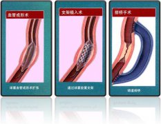 怎樣治療冠心病？