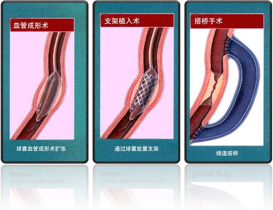 怎樣治療冠心??？(圖1)