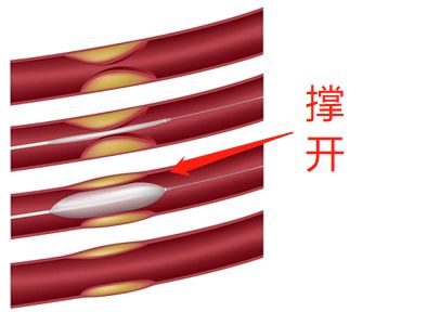 什么是藥物球囊？(圖2)